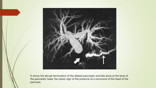 It shows the abrupt termination of the dilated pancreatic and bile ducts at the level of
the pancreatic head, the classic sign of the presence of a carcinoma of the head of the
pancreas.
 