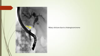 Biliary stricture due to cholangiocarcinoma
 
