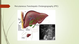 Percutaneous Transhepatic Cholangiography (PTC)
 