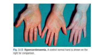 Approach to jaundice based on Harrison's | PPTX