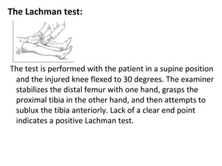 The Lachman test:
The test is performed with the patient in a supine position
and the injured knee flexed to 30 degrees. The examiner
stabilizes the distal femur with one hand, grasps the
proximal tibia in the other hand, and then attempts to
sublux the tibia anteriorly. Lack of a clear end point
indicates a positive Lachman test.
 