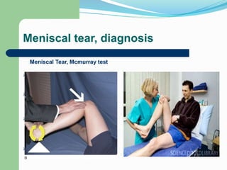 Meniscal tear, diagnosis
Meniscal Tear, Mcmurray test




 
