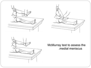 McMurray test to assess the
.medial meniscus
 