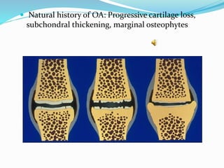 QuickTime™ and a
Photo CD Decompressor
are needed to use this picture
 Natural history of OA: Progressive cartilage loss,
subchondral thickening, marginal osteophytes
 