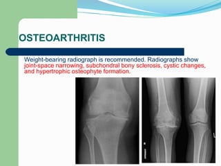 OSTEOARTHRITIS
Weight-bearing radiograph is recommended. Radiographs show
joint-space narrowing, subchondral bony sclerosis, cystic changes,
and hypertrophic osteophyte formation.
 