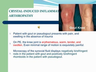 CRYSTAL-INDUCED INFLAMMATORY
ARTHROPATHY
Patient with gout or pseudogout presents with pain, and

swelling in the absence of trauma
On PE, the knee joint is erythematous, warm, tender, and
swollen. Even minimal range of motion is exquisitely painful.

Microscopy of the synovial fluid displays negatively birefringent
rods in the patient with gout and positively birefringent
rhomboids in the patient with pseudogout.

 