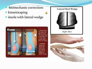  biomechanic correction:
 kinseiotaping
 insole with lateral wedge
 