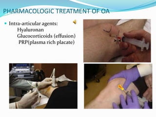 PHARMACOLOGIC TREATMENT OF OA
 Intra-articular agents:
Hyaluronan
Glucocorticoids (effusion)
PRP(plasma rich placate)
 