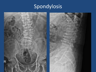 Spondylosis
 