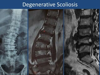 Degenerative Scoliosis
 