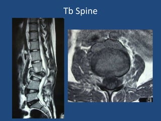 Tb Spine
 