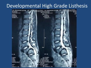 Developmental High Grade Listhesis
 