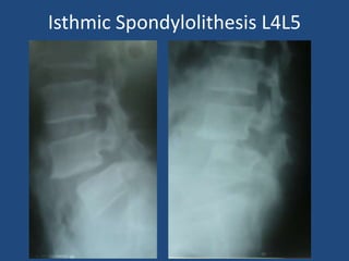 Isthmic Spondylolithesis L4L5
 