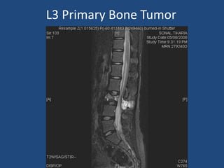 L3 Primary Bone Tumor
 
