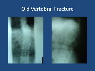 Old Vertebral Fracture
 
