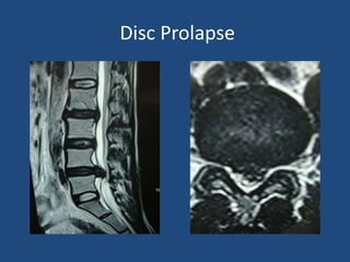 Disc Prolapse
 