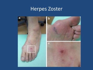 Herpes Zoster
 