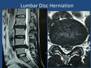 Lumbar Disc Herniation
 