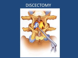 DISCECTOMY
 