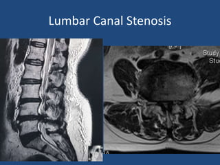 Lumbar Canal Stenosis
 