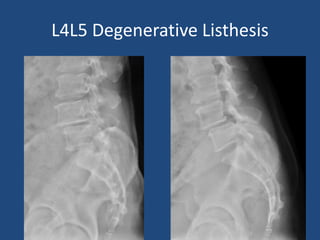 L4L5 Degenerative Listhesis
 