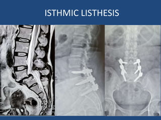 ISTHMIC LISTHESIS
 