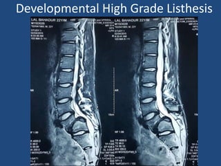 Developmental High Grade Listhesis
 