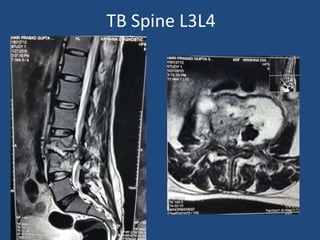 TB Spine L3L4
 