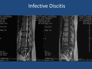 Infective Discitis
 