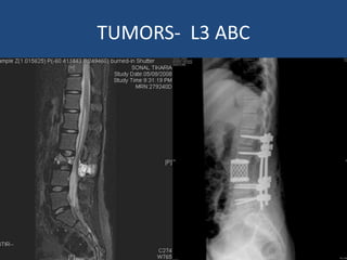 TUMORS- L3 ABC
 