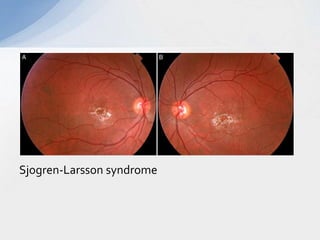 Sjogren-Larsson syndrome
 