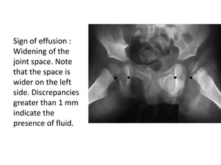 Sign of effusion :
Widening of the
joint space. Note
that the space is
wider on the left
side. Discrepancies
greater than ...