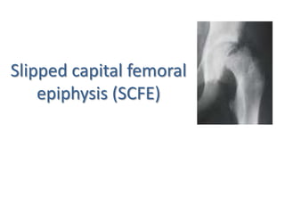 INTRODUCTION
The capital femoral epiphysis is
somewhat unique. It is one of the few
epiphyses in the body that is inside t...