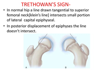 SHAM’S SIGN In the normal hip the inferiomedial femoral neck overlaps
the posterior wall of the acetabulum producing tria...