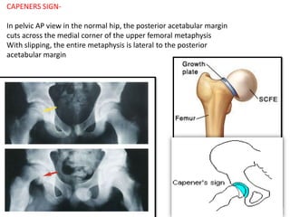 USG-It has been useful in the detection of early slips -joint
effusion and a “step” between the femoral neck and the
epiph...