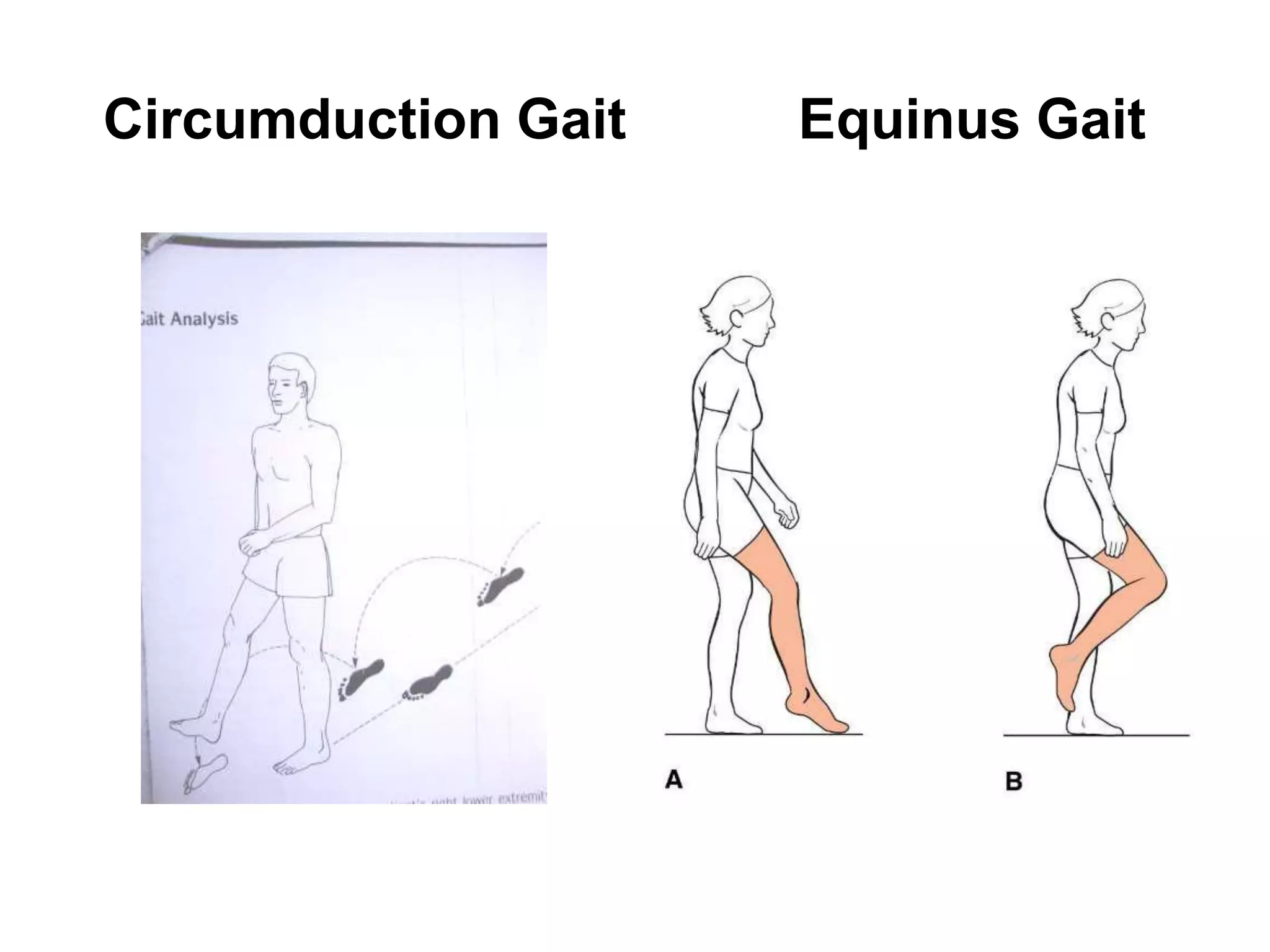 Circumduction Gait Equinus Gait
 