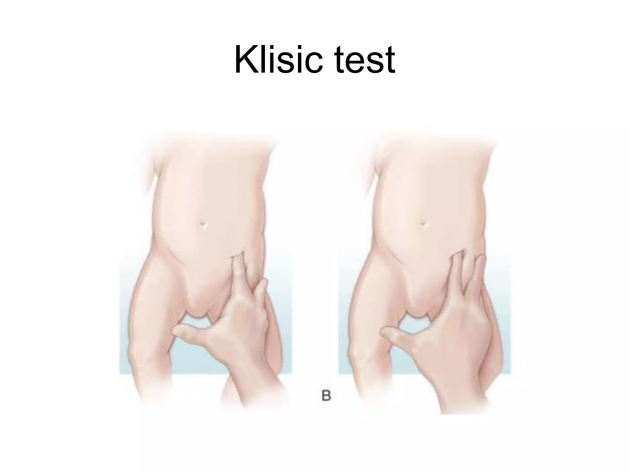 Klisic test
 