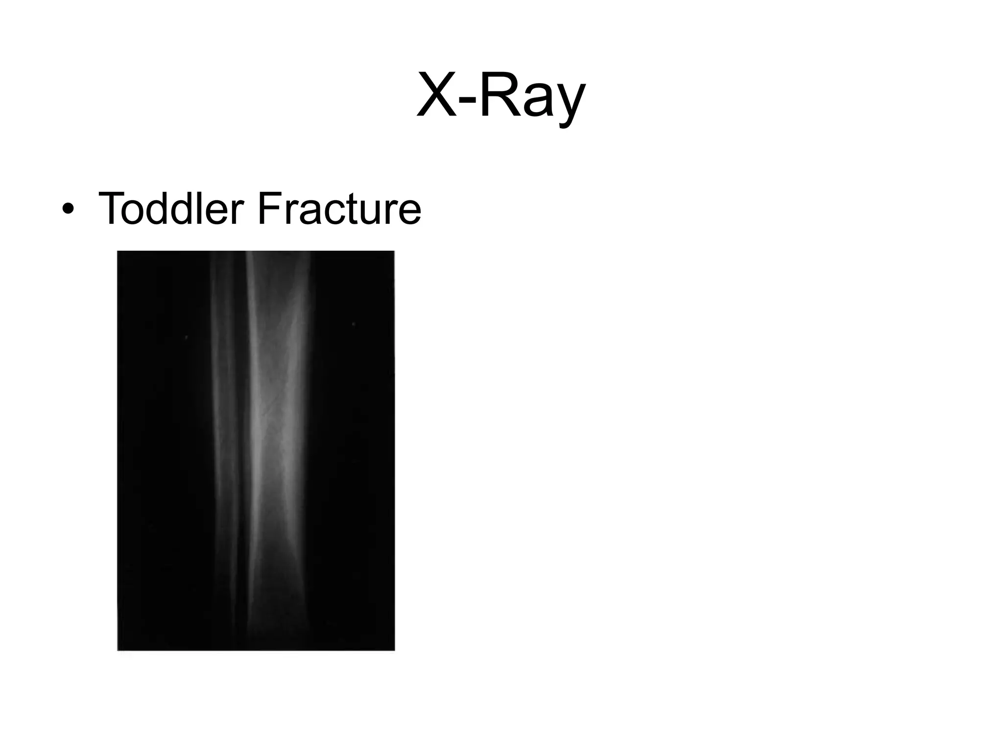 X-Ray
• Toddler Fracture
 
