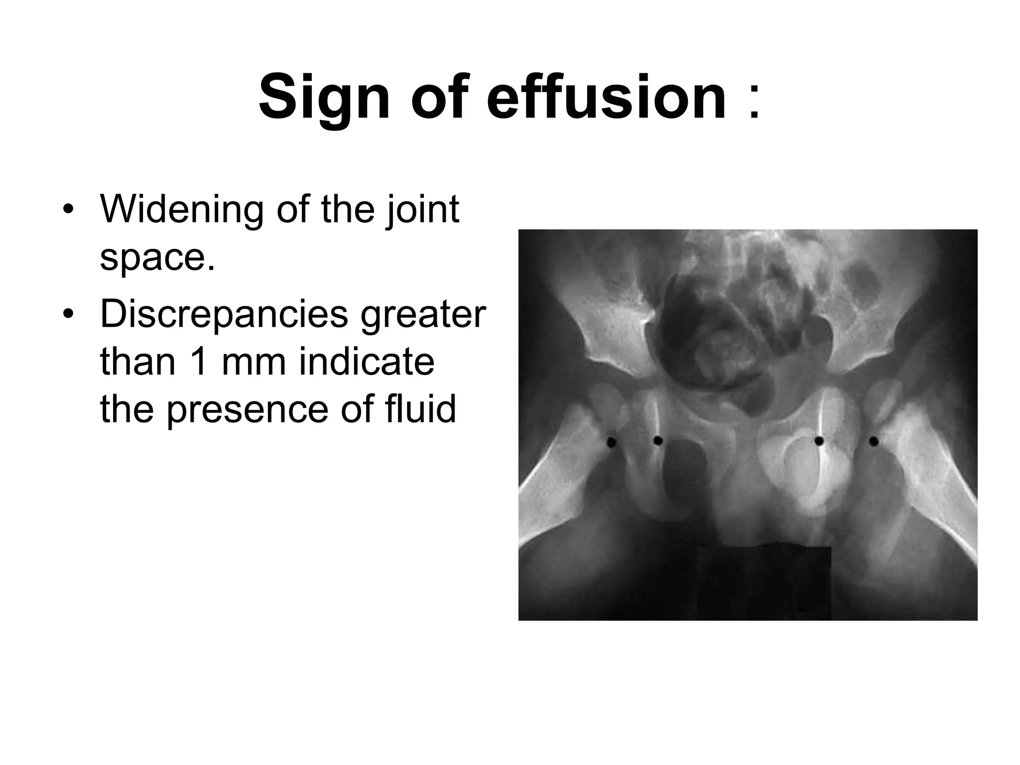 Sign of effusion :
• Widening of the joint
space.
• Discrepancies greater
than 1 mm indicate
the presence of fluid
 
