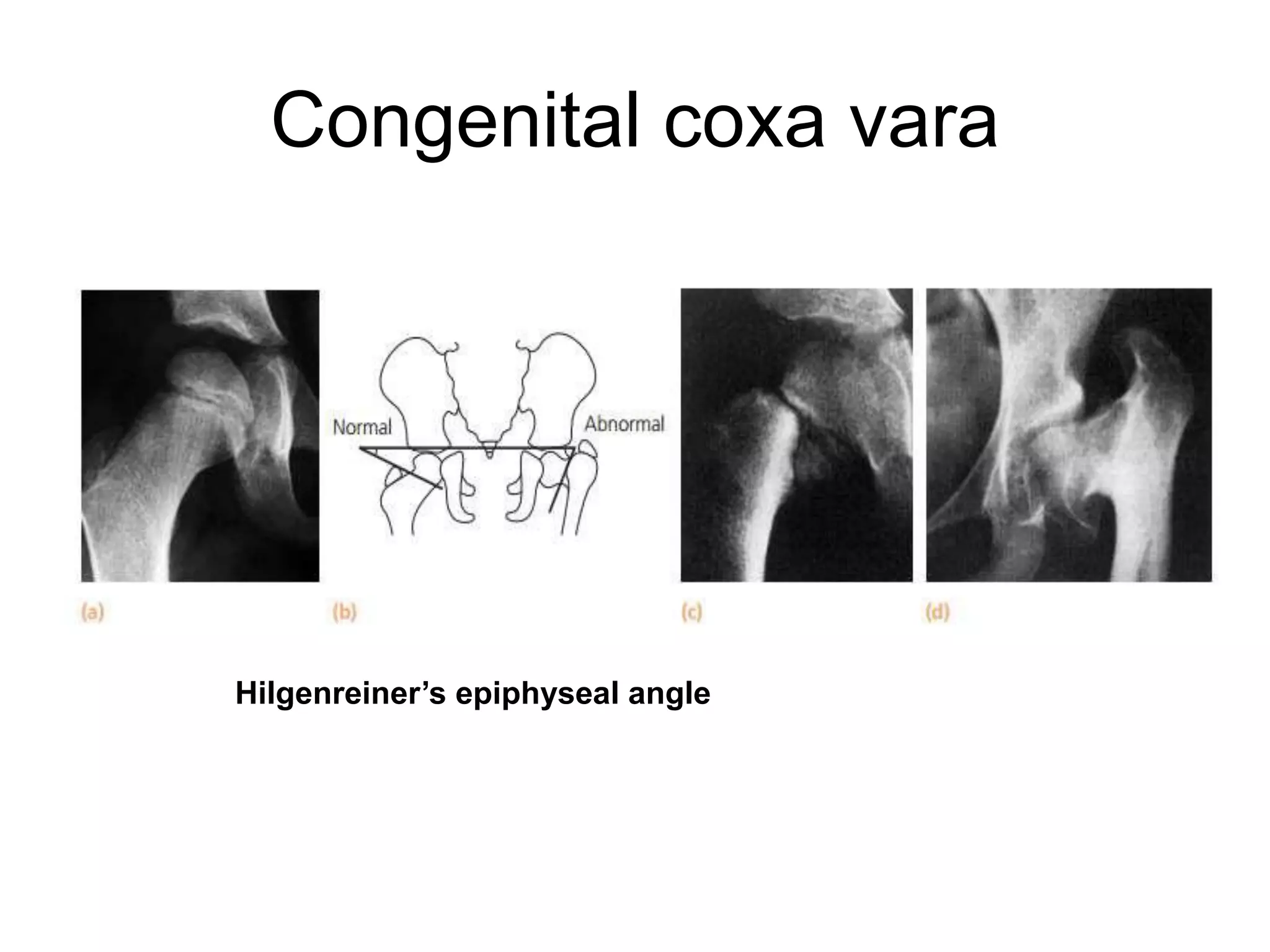 Congenital coxa vara
Hilgenreiner’s epiphyseal angle
 