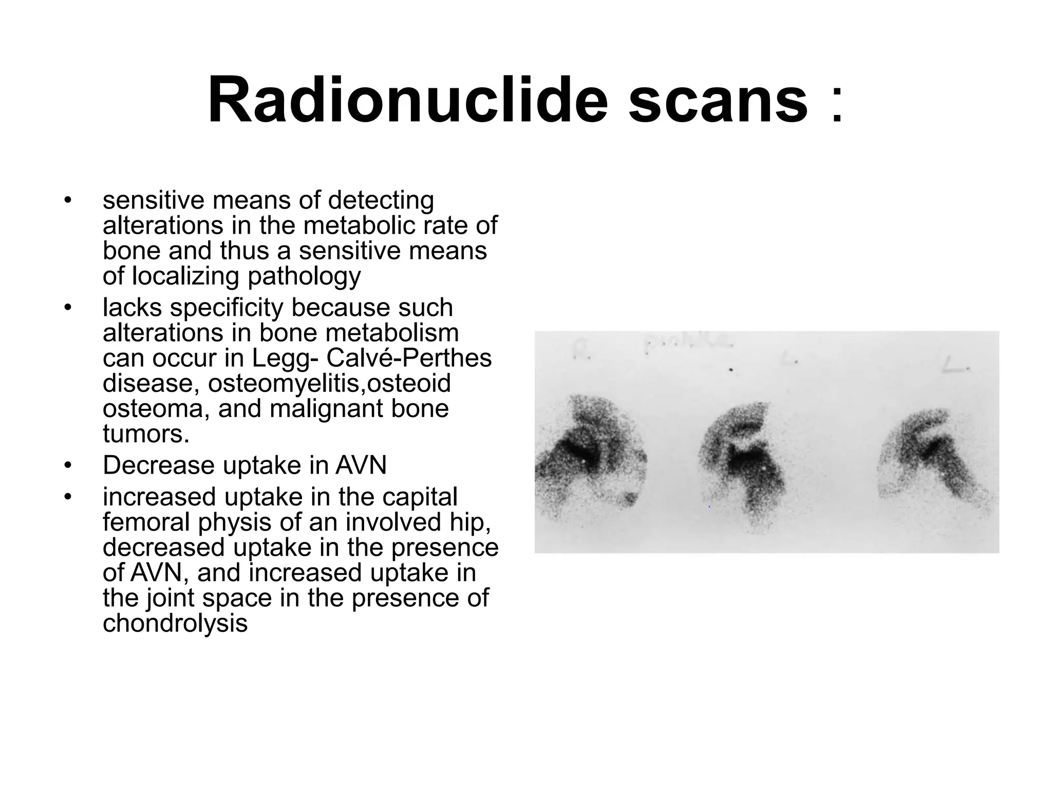 Radionuclide scans :
• sensitive means of detecting
alterations in the metabolic rate of
bone and thus a sensitive means
of localizing pathology
• lacks specificity because such
alterations in bone metabolism
can occur in Legg- Calvé-Perthes
disease, osteomyelitis,osteoid
osteoma, and malignant bone
tumors.
• Decrease uptake in AVN
• increased uptake in the capital
femoral physis of an involved hip,
decreased uptake in the presence
of AVN, and increased uptake in
the joint space in the presence of
chondrolysis
 