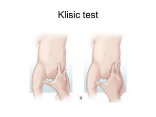 Klisic test
 