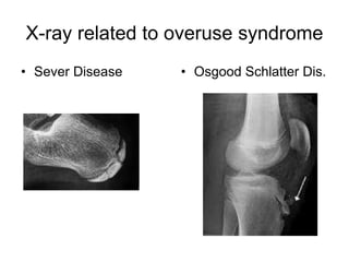 X-ray related to overuse syndrome
• Sever Disease • Osgood Schlatter Dis.
 