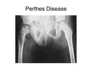 Perthes Disease
 