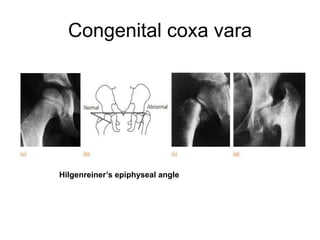 Congenital coxa vara
Hilgenreiner’s epiphyseal angle
 