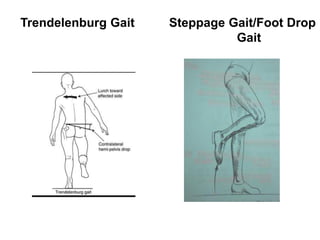 Trendelenburg Gait Steppage Gait/Foot Drop
Gait
 