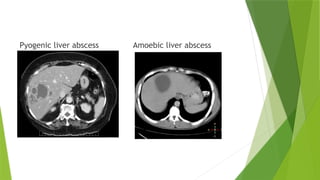 APPROACH TO LIVER CYST- KARTHIKEYAN [Autosaved].pptx