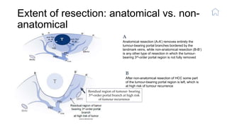 Extent of resection: anatomical vs. non-
anatomical
Residual region of tumour- bearing
3rd-order portal branch at high risk
of tumour recurrence
A
Anatomical resection (A-A’) removes entirely the
tumour-bearing portal branches bordered by the
landmark veins, while non-anatomical resection (B-B’)
is any other type of resection in which the tumour-
bearing 3rd-order portal region is not fully removed
B
After non-anatomical resection of HCC some part
of the tumour-bearing portal region is left, which is
at high risk of tumour recurrence
 
