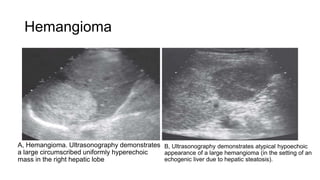 Hemangioma
A, Hemangioma. Ultrasonography demonstrates
a large circumscribed uniformly hyperechoic
mass in the right hepatic lobe
B, Ultrasonography demonstrates atypical hypoechoic
appearance of a large hemangioma (in the setting of an
echogenic liver due to hepatic steatosis).
 