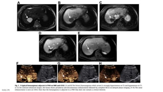 Hepatic haemangiomas: imaging
EASL CPG benign liver tumours. J Hepatol 2016;65:386–98
T2 T1 CE
Typical haemangioma adjacent to FNH
MRI
CEUS
CE CE
Strongly
hyperintense
Hypointense Lesion shows peripheral and discontinuous enhancement followed by
complete fill-in on delayed-phase imaging
 